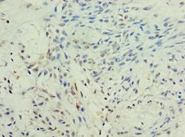 KMO Antibody - Immunohistochemistry of paraffin-embedded human breast cancer using antibody at 1:100 dilution.