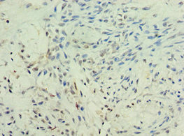 KMO Antibody - Immunohistochemistry of paraffin-embedded human breast cancer using KMO Antibody at dilution of 1:100