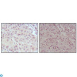 KMT2A / MLL Antibody - Immunohistochemistry (IHC) analysis of paraffin-embedded human lung cancer (left) and esophagus cancer (right), showing nuclear localization with DAB staining using MLL Monoclonal Antibody.