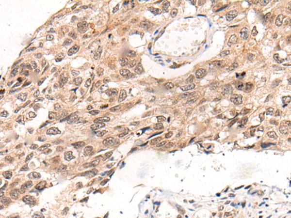 KNOP1 / C16orf88 Antibody - Immunohistochemistry of paraffin-embedded Human esophagus cancer tissue  using KNOP1 Polyclonal Antibody at dilution of 1:85(×200)