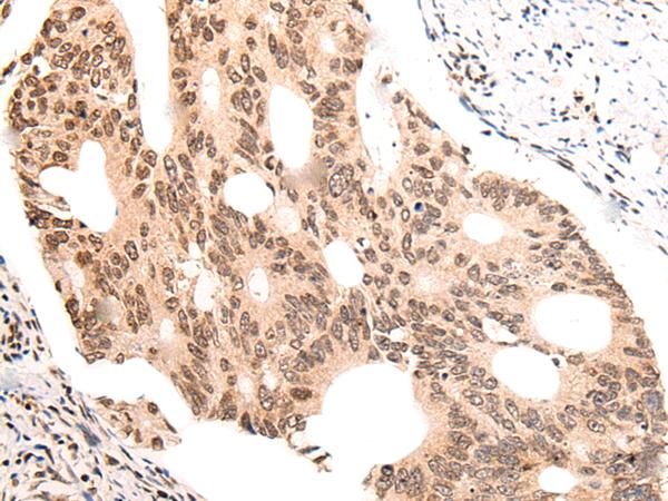 KNOP1 / C16orf88 Antibody - Immunohistochemistry of paraffin-embedded Human colorectal cancer tissue  using KNOP1 Polyclonal Antibody at dilution of 1:55(×200)