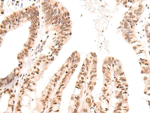 KNOP1 / C16orf88 Antibody - Immunohistochemistry of paraffin-embedded Human liver cancer tissue  using KNOP1 Polyclonal Antibody at dilution of 1:55(×200)