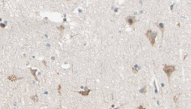 KPI-2 / LMTK2 Antibody - 1:100 staining human brain carcinoma tissue by IHC-P. The sample was formaldehyde fixed and a heat mediated antigen retrieval step in citrate buffer was performed. The sample was then blocked and incubated with the antibody for 1.5 hours at 22°C. An HRP conjugated goat anti-rabbit antibody was used as the secondary.