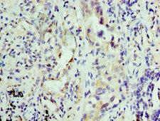 KPNA1 / Importin Alpha 5 Antibody - Immunohistochemistry of paraffin-embedded human lung cancer using KPNA1 Antibody at dilution of 1:100