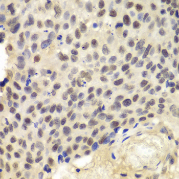 KPNA1 / Importin Alpha 5 Antibody - Immunohistochemistry of paraffin-embedded human lung cancer using KPNA1 antibodyat dilution of 1:100 (40x lens).