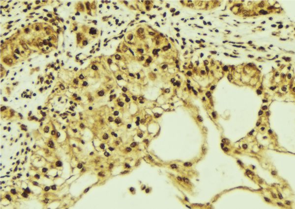 KPNA1 / Importin Alpha 5 Antibody - 1:100 staining human breast carcinoma tissue by IHC-P. The sample was formaldehyde fixed and a heat mediated antigen retrieval step in citrate buffer was performed. The sample was then blocked and incubated with the antibody for 1.5 hours at 22°C. An HRP conjugated goat anti-rabbit antibody was used as the secondary.