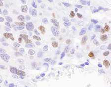 KPNA2 / Importin Alpha 1 Antibody - Detection of Human RCH1 by Immunohistochemistry. Sample: FFPE section of human ovarian carcinoma. Antibody: Affinity purified rabbit anti-RCH1 used at a dilution of 1:1000 (1 ug/ml). Detection: DAB.