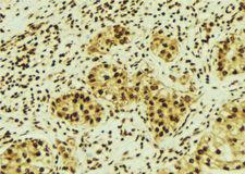 KPNA2 / Importin Alpha 1 Antibody - 1:100 staining human breast carcinoma tissue by IHC-P. The sample was formaldehyde fixed and a heat mediated antigen retrieval step in citrate buffer was performed. The sample was then blocked and incubated with the antibody for 1.5 hours at 22°C. An HRP conjugated goat anti-rabbit antibody was used as the secondary.