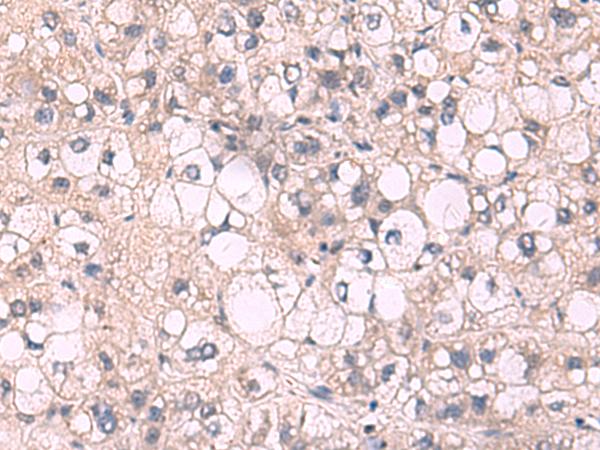 KPNA2 / Importin Alpha 1 Antibody - Immunohistochemistry of paraffin-embedded Human liver cancer tissue  using KPNA2 Polyclonal Antibody at dilution of 1:85(×200)