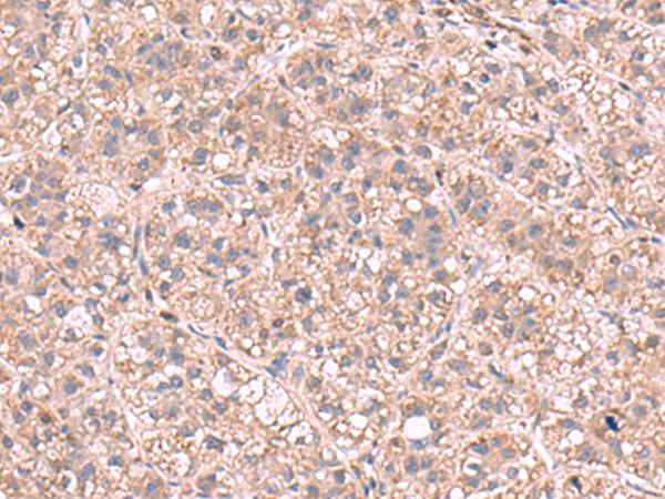 KPNA2 / Importin Alpha 1 Antibody - Immunohistochemistry of paraffin-embedded Human liver cancer tissue  using KPNA2 Polyclonal Antibody at dilution of 1:60(×200)