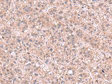 KPNA2 / Importin Alpha 1 Antibody - Immunohistochemistry of paraffin-embedded Human liver cancer tissue  using KPNA2 Polyclonal Antibody at dilution of 1:60(×200)