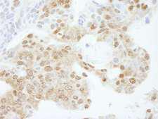 KPNA3 / Importin Alpha 4 Antibody - Detection of Human KPNA3 by Immunohistochemistry. Sample: FFPE section of human ovarian carcinoma. Antibody: Affinity purified rabbit anti-KPNA3 used at a dilution of 1:250.