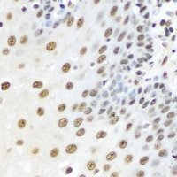KPNA3 / Importin Alpha 4 Antibody - Immunohistochemical analysis of Karyopherin alpha-3 staining in human esophageal cancer formalin fixed paraffin embedded tissue section. The section was pre-treated using heat mediated antigen retrieval with sodium citrate buffer (pH 6.0). The section was then incubated with the antibody at room temperature and detected using an HRP conjugated compact polymer system. DAB was used as the chromogen. The section was then counterstained with hematoxylin and mounted with DPX.