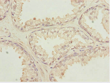 KPNA6 Antibody - Immunohistochemistry of paraffin-embedded human prostate cancer at dilution 1:100