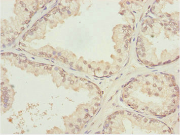 KPNA6 Antibody - Immunohistochemistry of paraffin-embedded human prostate cancer at dilution 1:100