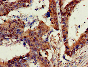 KRAS Antibody - Immunohistochemistry of paraffin-embedded human colon cancer at dilution of 1:100
