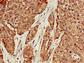 KRAS Antibody - Immunohistochemistry of paraffin-embedded human ovarian cancer at dilution of 1:100