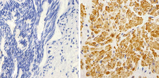 KRAS Antibody - IHC (P) of K-Ras Antibody (9.13) showing staining in the cytoplasm and membrane of paraffin-embedded human prostate carcinoma (right) compared to a negative control without primary antibody (left).