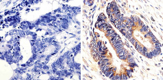 KRAS Antibody - IHC (P) using K-Ras Antibody (9.13) showing staining in the cytoplasm of paraffin-embedded human colon carcinoma (right) compared to a negative control without primary antibody (left).