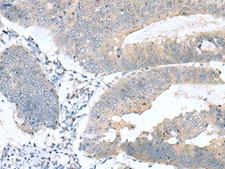 KRCC1 Antibody - Immunohistochemistry of paraffin-embedded Human colorectal cancer tissue  using KRCC1 Polyclonal Antibody at dilution of 1:60(×200)