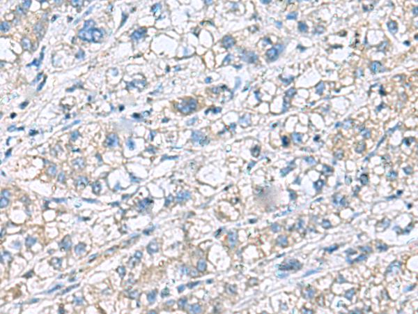 KRCC1 Antibody - Immunohistochemistry of paraffin-embedded Human liver cancer tissue  using KRCC1 Polyclonal Antibody at dilution of 1:60(×200)