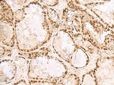 KRR1 Antibody - Immunohistochemistry of paraffin-embedded Human thyroid cancer tissue  using KRR1 Polyclonal Antibody at dilution of 1:50(×200)