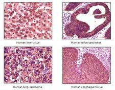 KRT1 / CK1 / Cytokeratin 1 Antibody - IHC analysis of FFPE liver tissue, colon carcinoma, lung carcinoma, and esophagus using DAB staining