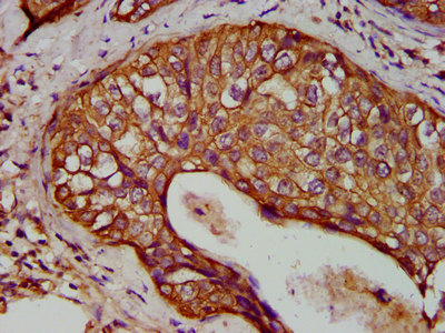 KRT1 / CK1 / Cytokeratin 1 Antibody - Immunohistochemistry image at a dilution of 1:400 and staining in paraffin-embedded human cervical cancer performed on a Leica BondTM system. After dewaxing and hydration, antigen retrieval was mediated by high pressure in a citrate buffer (pH 6.0) . Section was blocked with 10% normal goat serum 30min at RT. Then primary antibody (1% BSA) was incubated at 4 °C overnight. The primary is detected by a biotinylated secondary antibody and visualized using an HRP conjugated SP system.