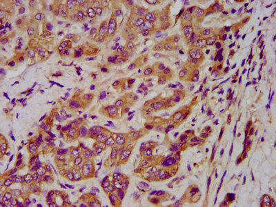 KRT1 / CK1 / Cytokeratin 1 Antibody - Immunohistochemistry image at a dilution of 1:400 and staining in paraffin-embedded human liver cancer performed on a Leica BondTM system. After dewaxing and hydration, antigen retrieval was mediated by high pressure in a citrate buffer (pH 6.0) . Section was blocked with 10% normal goat serum 30min at RT. Then primary antibody (1% BSA) was incubated at 4 °C overnight. The primary is detected by a biotinylated secondary antibody and visualized using an HRP conjugated SP system.