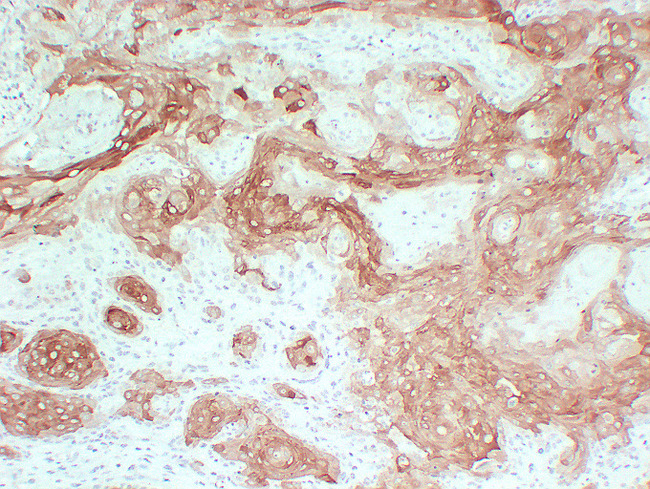 KRT10 / CK10 / Cytokeratin 10 Antibody - Cutaneous Squamous Cell Carcinomas 3