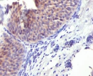 KRT10 / CK10 / Cytokeratin 10 Antibody - IHC testing of FFPE human bladder carcinoma and Keratin 10 antibody (clone CTKN10-1).  This image was taken for the unmodified form of this product. Other forms have not been tested.