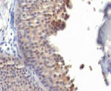 KRT10 / CK10 / Cytokeratin 10 Antibody - Formalin-fixed, paraffin-embedded human bladder carcinoma stained with anti-Keratin 10 antibody (KRT10/1275).  This image was taken for the unmodified form of this product. Other forms have not been tested.