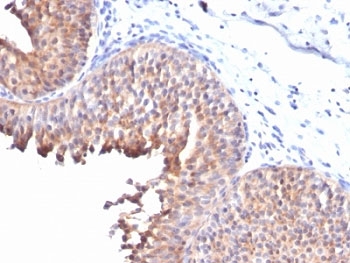 KRT10 / CK10 / Cytokeratin 10 Antibody - Formalin-fixed, paraffin-embedded human bladder carcinoma stained with Keratin 10 antibody (KRT10/844).  This image was taken for the unmodified form of this product. Other forms have not been tested.