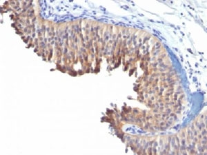 KRT10 / CK10 / Cytokeratin 10 Antibody - IHC testing of human bladder carcinoma with Keratin 10 antibody (clone LH2). This image was taken for the unmodified form of this product. Other forms have not been tested.