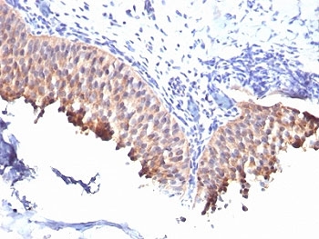 KRT10 / CK10 / Cytokeratin 10 Antibody - Formalin-fixed, paraffin-embedded human bladder carcinoma stained with Cytokeratin 10 antibody (SPM261).  This image was taken for the unmodified form of this product. Other forms have not been tested.