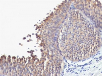 KRT10 / CK10 / Cytokeratin 10 Antibody - IHC testing of FFPE human bladder carcinoma with Cytokeratin 10 antibody (clone SPM623). Required HIER: boil tissue sections in 10mM citrate buffer, pH 6, for 10-20 min.