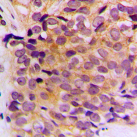 KRT10 / CK10 / Cytokeratin 10 Antibody - Immunohistochemical analysis of Cytokeratin 10 staining in human breast cancer formalin fixed paraffin embedded tissue section. The section was pre-treated using heat mediated antigen retrieval with sodium citrate buffer (pH 6.0). The section was then incubated with the antibody at room temperature and detected using an HRP conjugated compact polymer system. DAB was used as the chromogen. The section was then counterstained with hematoxylin and mounted with DPX.