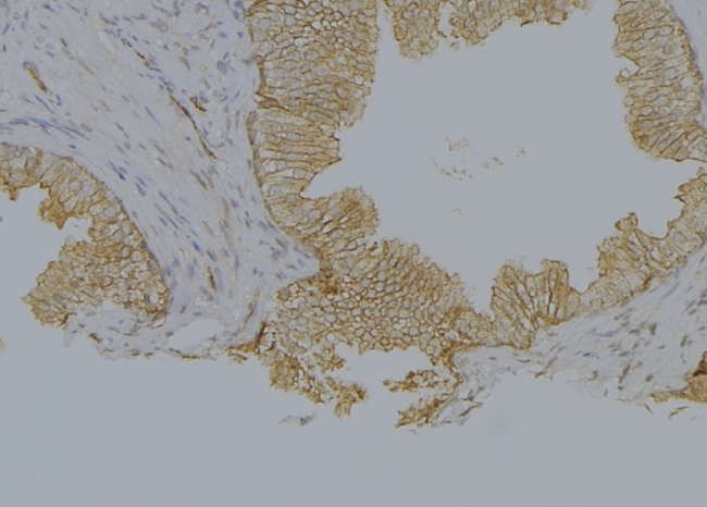 KRT10 / CK10 / Cytokeratin 10 Antibody - 1:100 staining human colon carcinoma tissue by IHC-P. The sample was formaldehyde fixed and a heat mediated antigen retrieval step in citrate buffer was performed. The sample was then blocked and incubated with the antibody for 1.5 hours at 22°C. An HRP conjugated goat anti-rabbit antibody was used as the secondary.