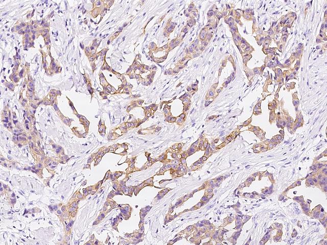 KRT10 / CK10 / Cytokeratin 10 Antibody - Immunochemical staining KRT10 in human breast carcinoma with rabbit polyclonal antibody at 1:200 dilution, formalin-fixed paraffin embedded sections.