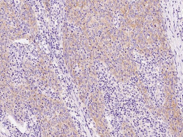 KRT10 / CK10 / Cytokeratin 10 Antibody - Immunochemical staining KRT10 in human lung cancer with rabbit polyclonal antibody at 1:200 dilution, formalin-fixed paraffin embedded sections.