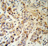 KRT13 / CK13 / Cytokeratin 13 Antibody - KRT13 Antibody (RB18903) IHC of formalin-fixed and paraffin-embedded human breast carcinoma followed by peroxidase-conjugated secondary antibody and DAB staining.