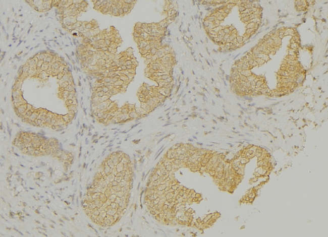 KRT13 / CK13 / Cytokeratin 13 Antibody - 1:100 staining human colon carcinoma tissue by IHC-P. The sample was formaldehyde fixed and a heat mediated antigen retrieval step in citrate buffer was performed. The sample was then blocked and incubated with the antibody for 1.5 hours at 22°C. An HRP conjugated goat anti-rabbit antibody was used as the secondary.