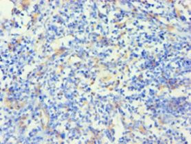 KRT14 / CK14 / Cytokeratin 14 Antibody - Immunohistochemistry of paraffin-embedded human cervical cancer using antibody at 1:100 dilution.  This image was taken for the unconjugated form of this product. Other forms have not been tested.