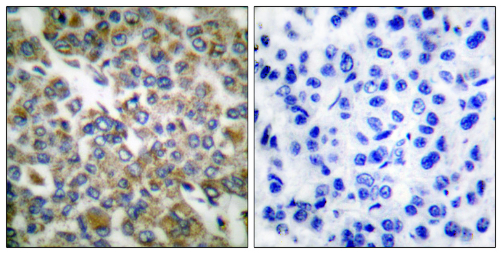 KRT14 / CK14 / Cytokeratin 14 Antibody - Immunohistochemistry analysis of paraffin-embedded human breast carcinoma tissue, using Keratin 14 Antibody. The picture on the right is blocked with the synthesized peptide.