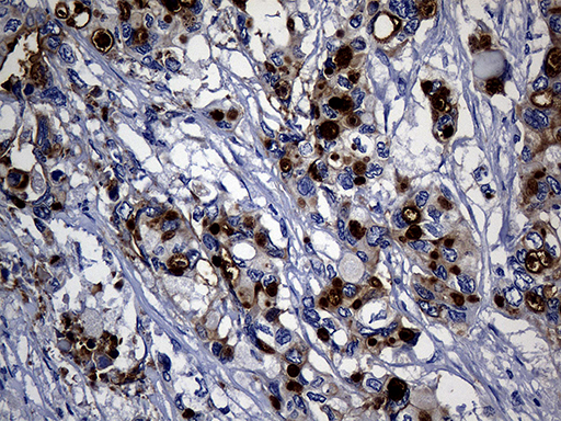 KRT14 / CK14 / Cytokeratin 14 Antibody - Immunohistochemical staining of paraffin-embedded Carcinoma of Human pancreas tissue using anti-KRT14 mouse monoclonal antibody. (Heat-induced epitope retrieval by 1mM EDTA in 10mM Tris buffer. (pH8.5) at 120°C for 3 min. (1:2000)