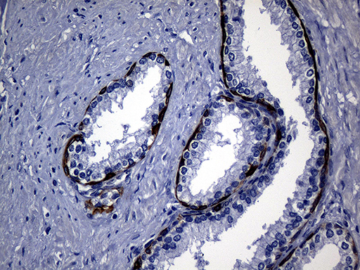 KRT14 / CK14 / Cytokeratin 14 Antibody - Immunohistochemical staining of paraffin-embedded Human prostate tissue within the normal limits using anti-KRT14 mouse monoclonal antibody. (Heat-induced epitope retrieval by 1mM EDTA in 10mM Tris buffer. (pH8.5) at 120°C for 3 min. (1:2000)