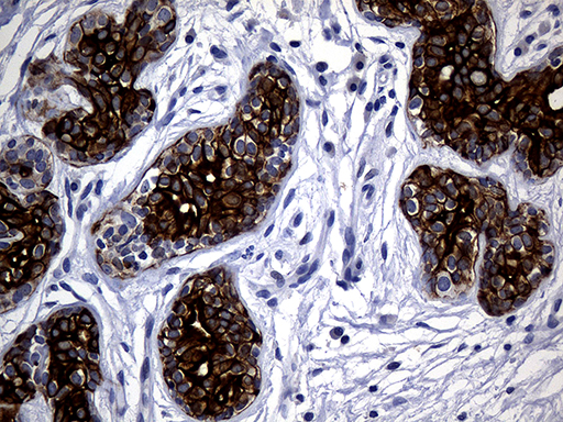 KRT14 / CK14 / Cytokeratin 14 Antibody - Immunohistochemical staining of paraffin-embedded Adenocarcinoma of Human breast tissue tissue using anti-KRT14 mouse monoclonal antibody. (Heat-induced epitope retrieval by 1mM EDTA in 10mM Tris buffer. (pH8.5) at 120°C for 3 min. (1:2000)