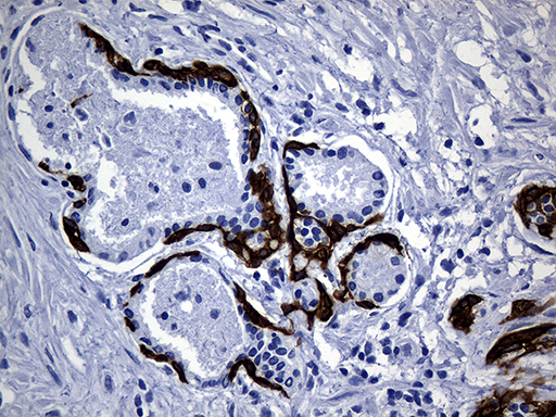 KRT14 / CK14 / Cytokeratin 14 Antibody - Immunohistochemical staining of paraffin-embedded Carcinoma of Human prostate tissue using anti-KRT14 mouse monoclonal antibody. (Heat-induced epitope retrieval by 1mM EDTA in 10mM Tris buffer. (pH8.5) at 120°C for 3 min. (1:2000)