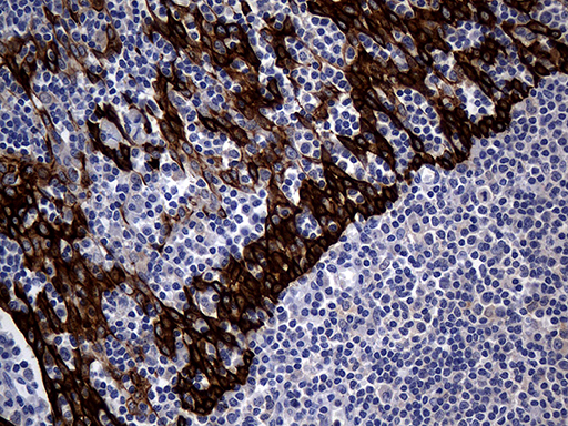 KRT14 / CK14 / Cytokeratin 14 Antibody - Immunohistochemical staining of paraffin-embedded Human tonsil within the normal limits using anti-KRT14 mouse monoclonal antibody. (Heat-induced epitope retrieval by 1mM EDTA in 10mM Tris buffer. (pH8.5) at 120°C for 3 min. (1:2000)