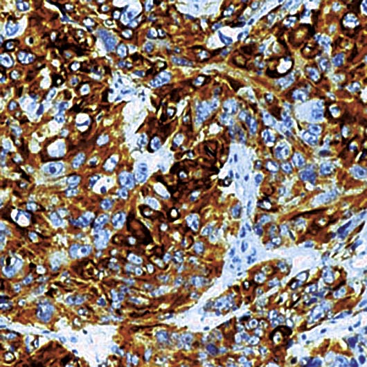 KRT14 / CK14 / Cytokeratin 14 Antibody - Formalin-fixed, paraffin-embedded human squamous cell carcinoma of lung stained with Cytokeratin 14 antibody.